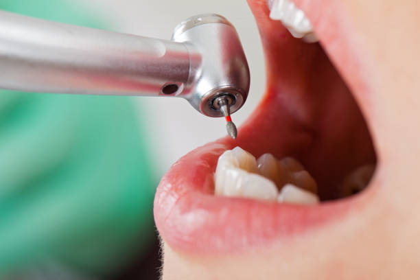 Best Emergency Root Canal Treatment in Kingsland, TX